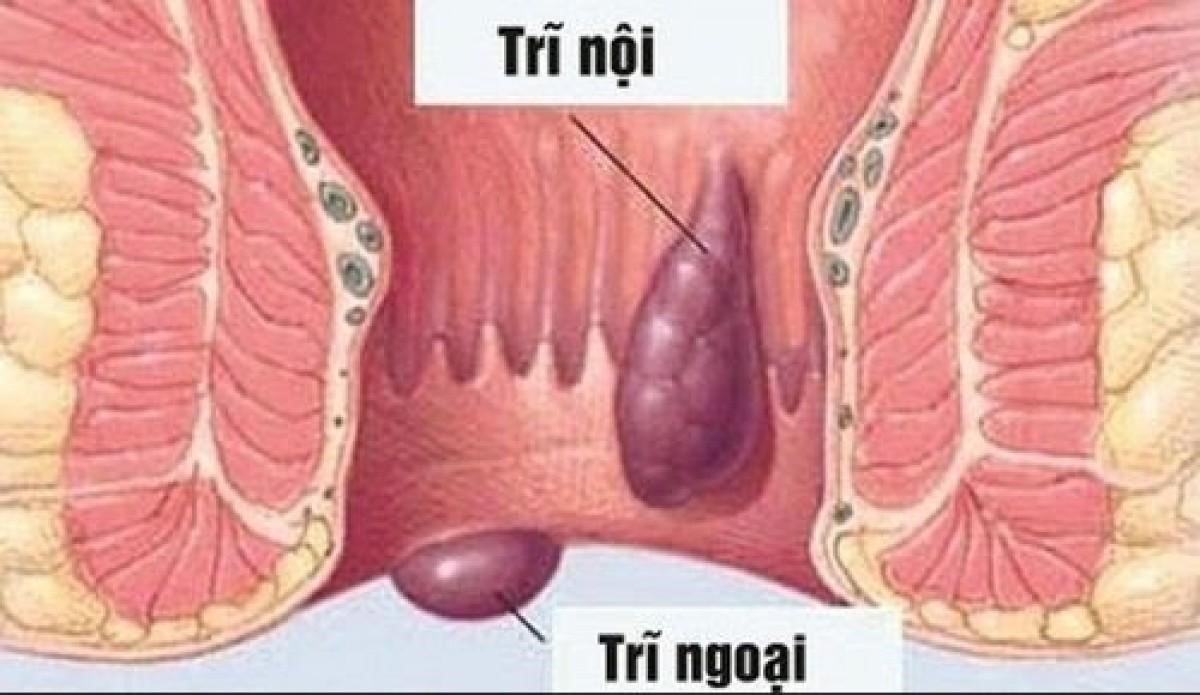trĩ