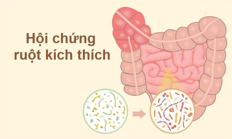 Hội chứng ruột kích thích là gì? Cách điều trị như thế nào hiệu quả?